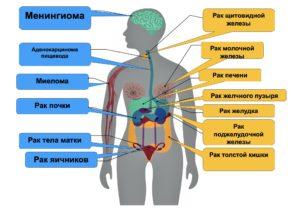 раковые заболевания